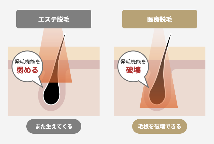 エステ脱毛との違い